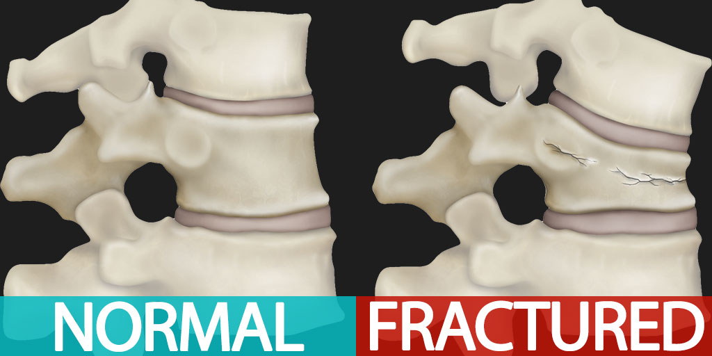 Normal Vertebrae vs. Fractured Vertebrae