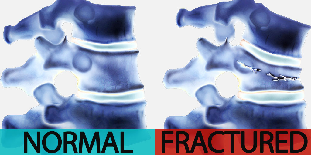 Normal Vertebrae vs. Fractured Vertebrae