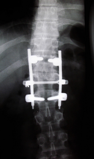 Back Fracture Hardware