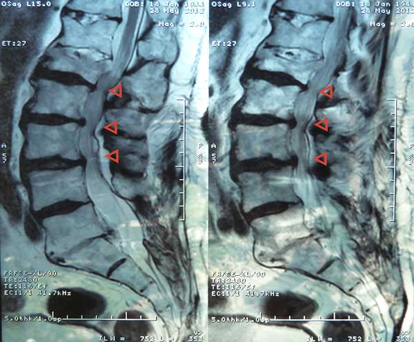 Spinal Stenosis X-ray