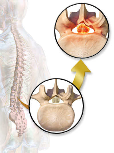 Spinal Stenosis Up Close