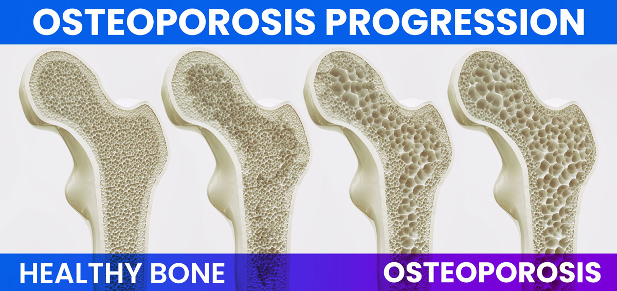 Osteoporosis Progression Bone Density Loss