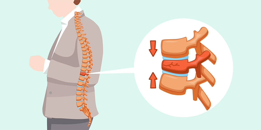 Spinal Compression Fracture