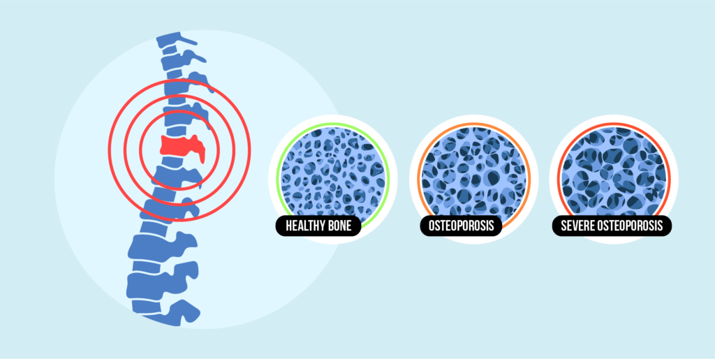 Recognizing Osteoporosis